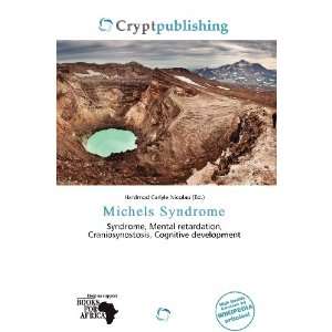  Michels Syndrome (9786200797728) Hardmod Carlyle Nicolao Books