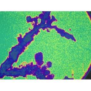  Chorionic Villi Sampling Placental Tissue Photographic 